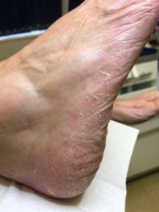 Athletes Foot Treatment