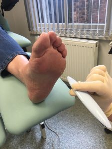 Diabetic Foot Treatment
