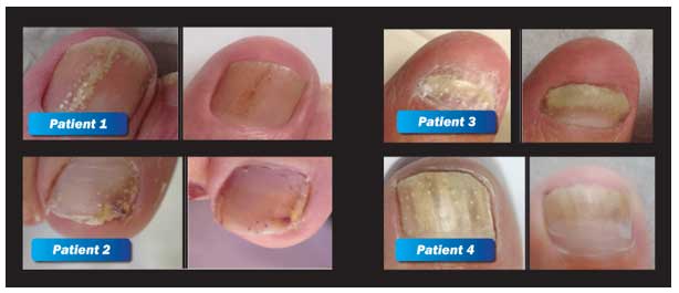 CLEARANAIL fungal nail treatment