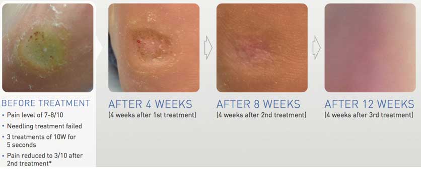 Swift Microwave Verruca Treatment - Before and After